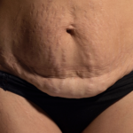 C Section Scar